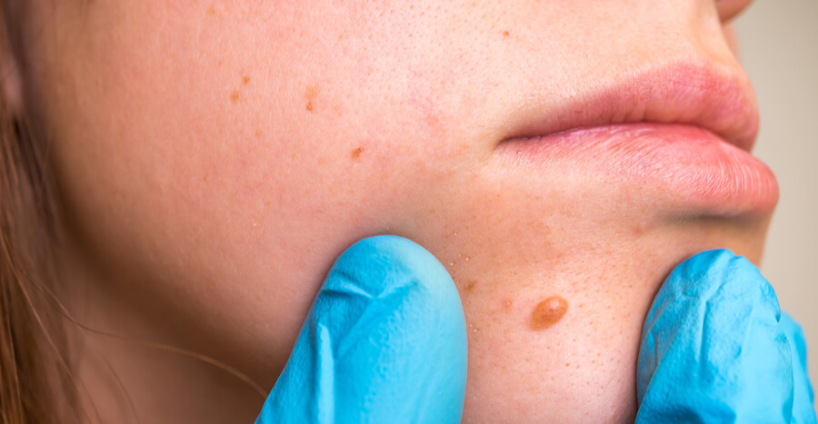 skin tag removal