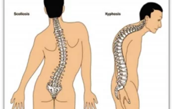 Photo of Non-Surgical Treatment for Scoliosis: How Chiropractic Care Can Help