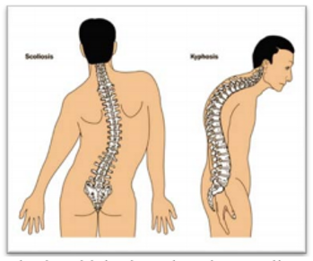 Scoliosis